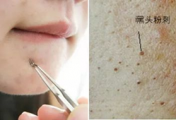 清理黑头粉刺视频,跟我学视频清洁术